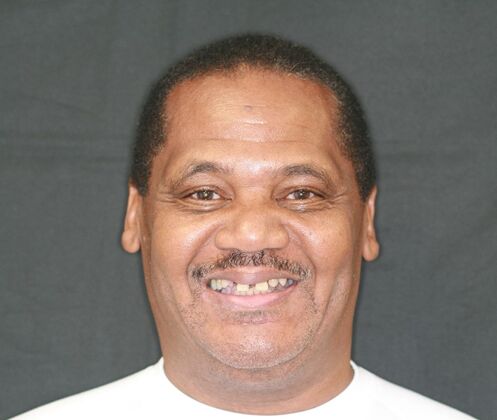 Dental Implants Case 1 - Before