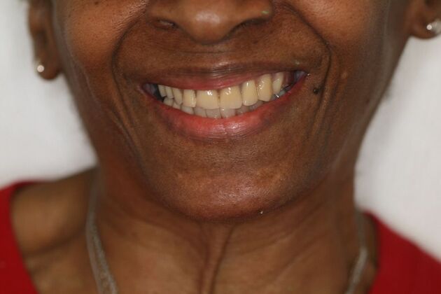 Dental Implants Case 2 - Before