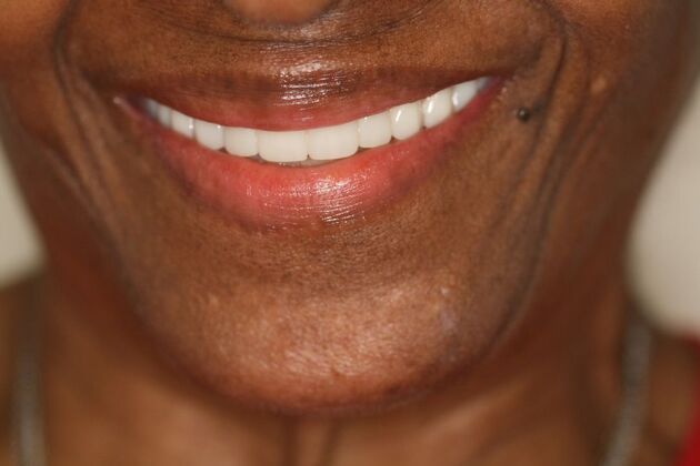 Dental Implants: Case 2 - After