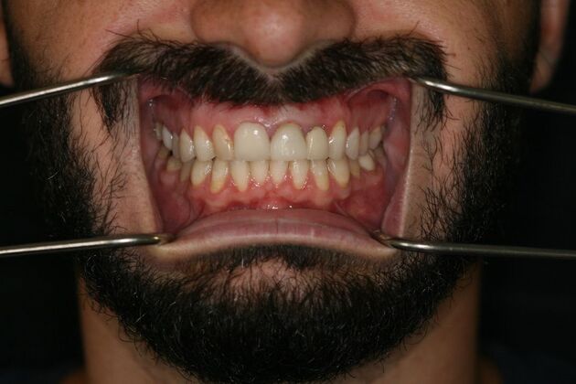 Porcelain Veneers: Case 7 - Before