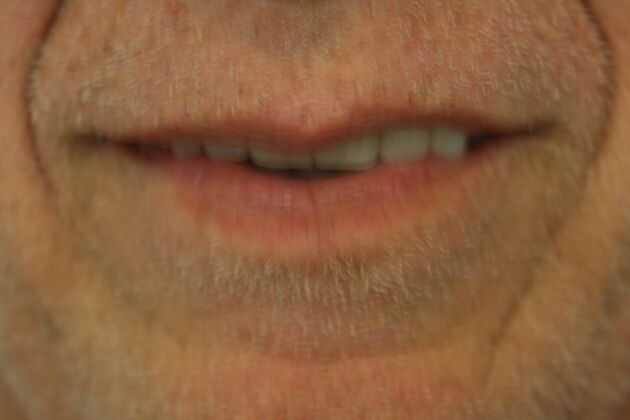 Dental Implants Case 3 - Before