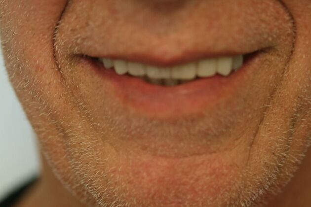 Dental Implants Case 3 - After