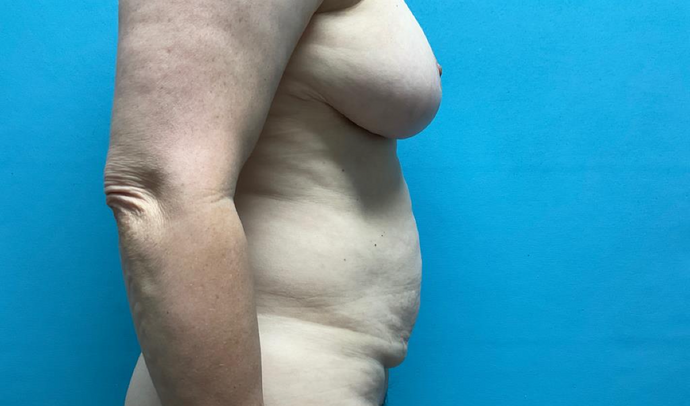 Tummy Tuck: Case 1 - Before