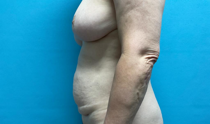 Tummy Tuck: Case 1 - Before