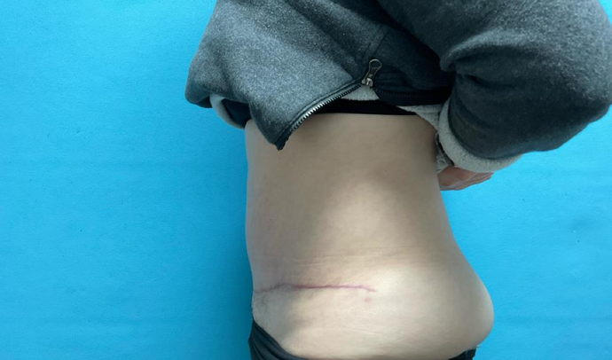 Tummy Tuck: Case 1 - After