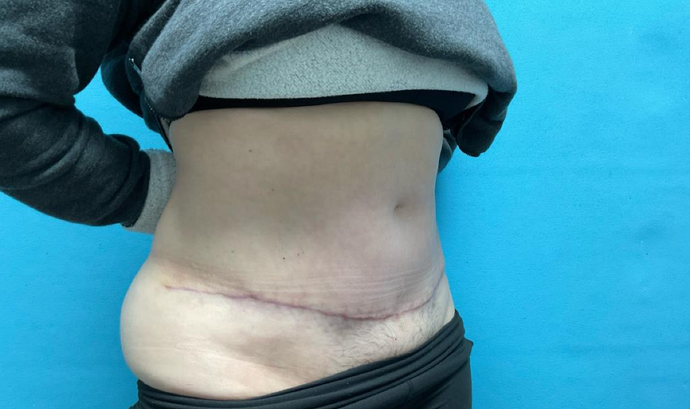 Tummy Tuck: Case 1 - After
