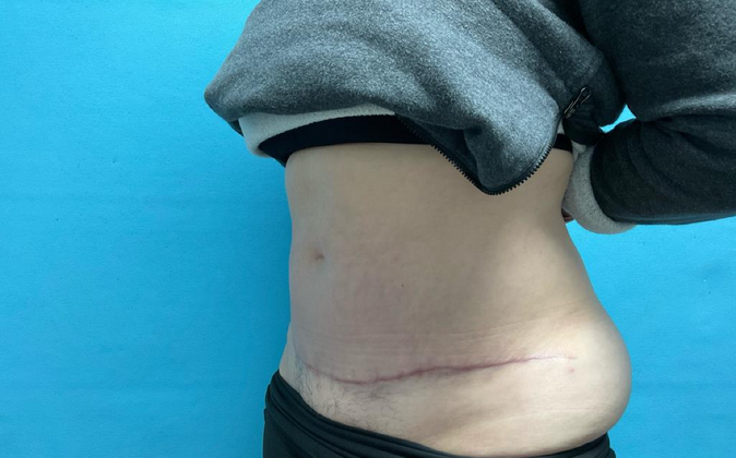 Tummy Tuck: Case 1 - After