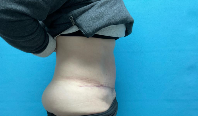 Tummy Tuck: Case 1 - After