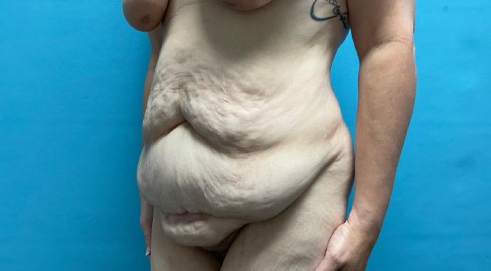 Tummy Tuck: Case 2 - Before