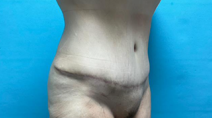 Tummy Tuck: Case 2 - After