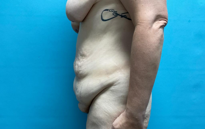 Tummy Tuck: Case 2 - Before