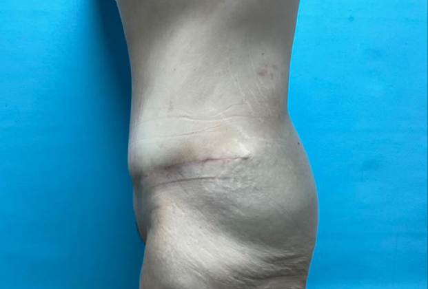 Tummy Tuck: Case 2 - After