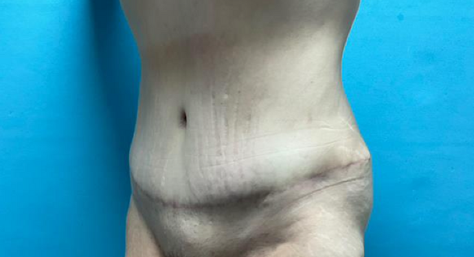 Tummy Tuck: Case 2 - After