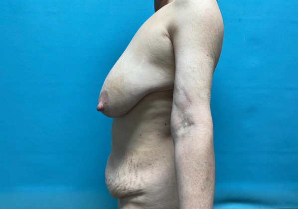 Mommy Makeover: Case 25 - Before