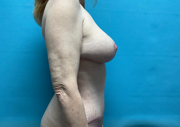 Mommy Makeover: Case 25 - After