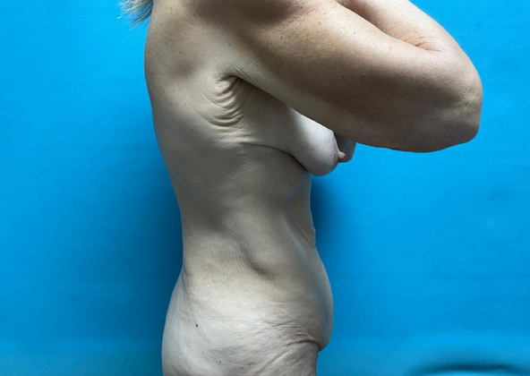 Mommy Makeover: Case 26 - Before