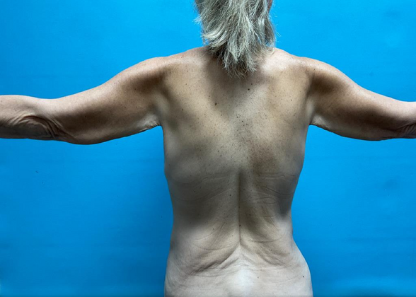 Mommy Makeover: Case 26 - Before