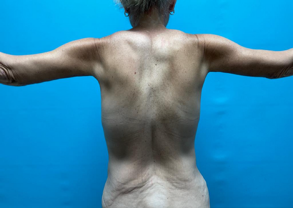 Mommy Makeover: Case 26 - After