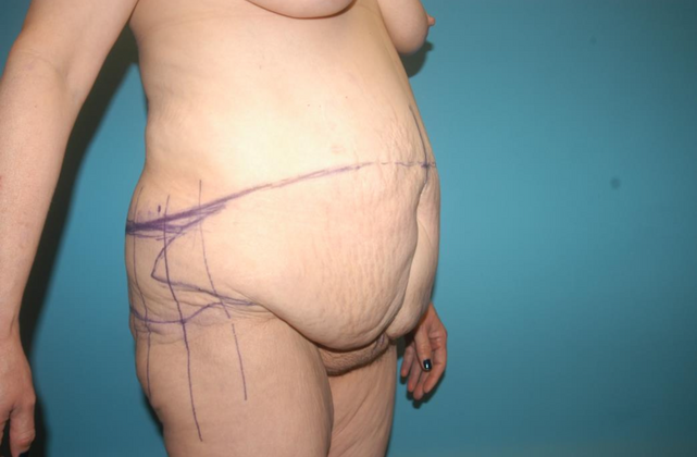 Tummy Tuck: Case 3 - Before