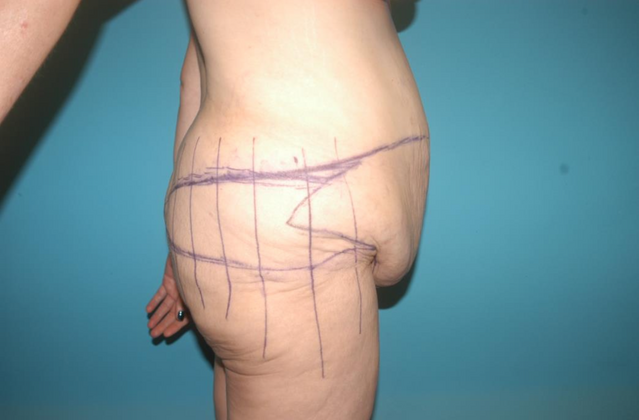 Tummy Tuck: Case 3 - Before