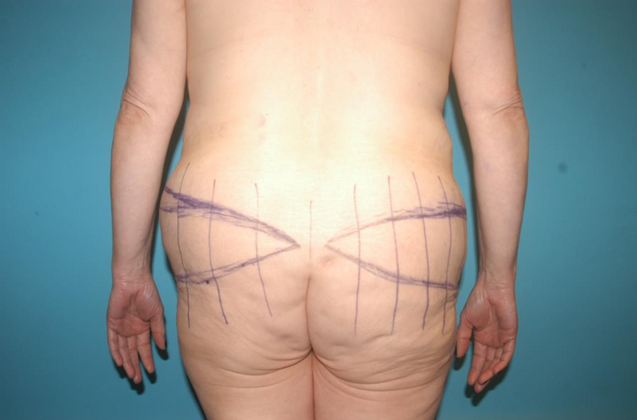 Tummy Tuck: Case 3 - Before