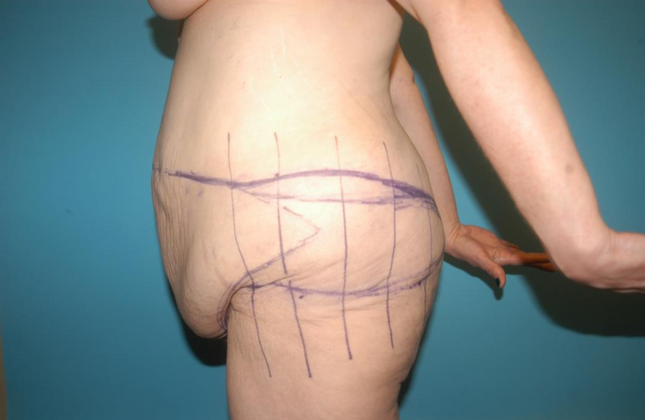 Tummy Tuck: Case 3 - Before