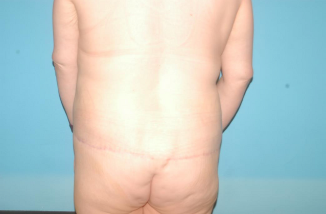 Tummy Tuck: Case 3 - After