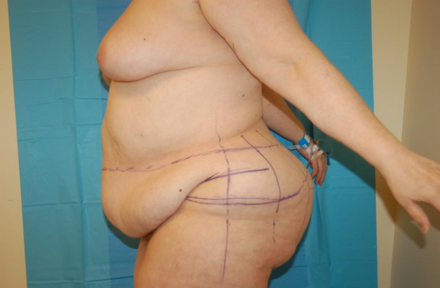 Mommy Makeover: Case 27 - Before