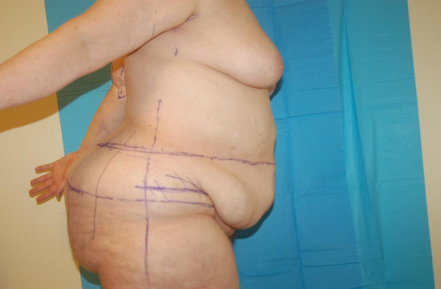 Mommy Makeover: Case 27 - Before