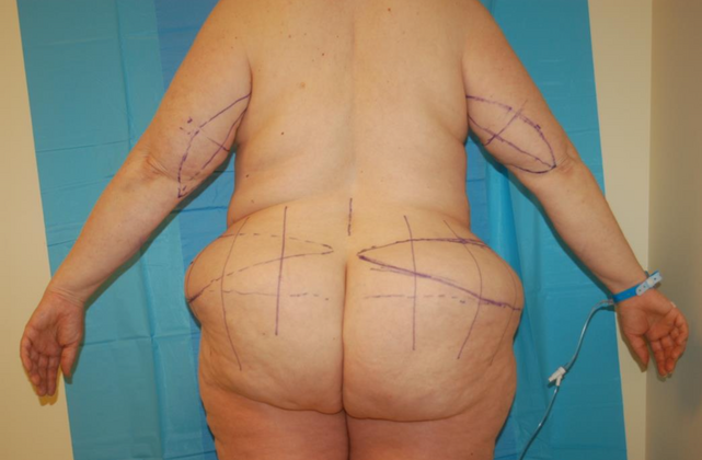 Mommy Makeover: Case 27 - Before