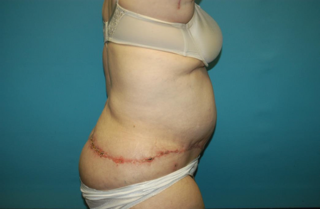 Mommy Makeover: Case 27 - After