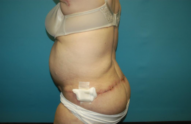 Mommy Makeover: Case 27 - After