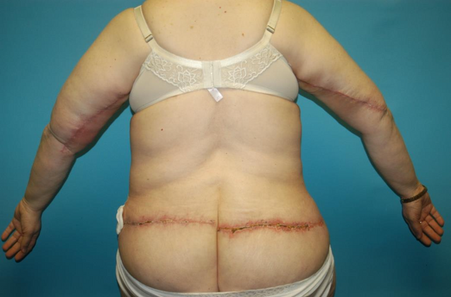 Mommy Makeover: Case 27 - After