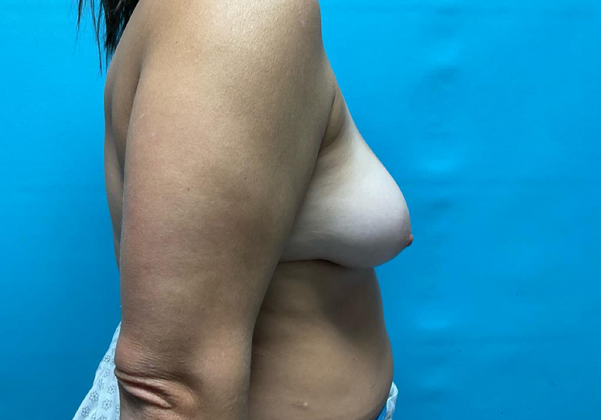 Breast Augmentation: Case 1 - Before