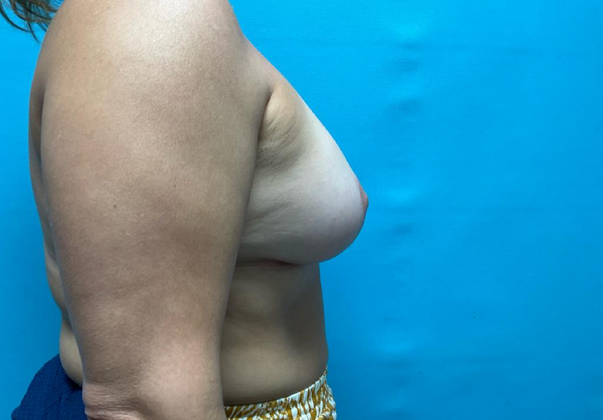 Breast Augmentation: Case 1 - After