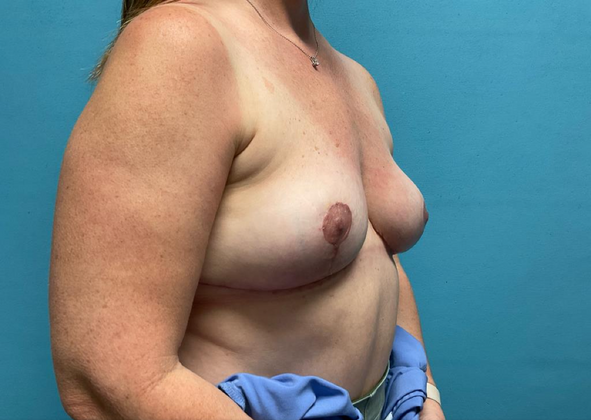 Breast Augmentation: Case 2 - After