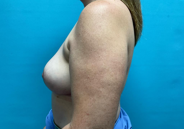 Breast Augmentation: Case 2 - After