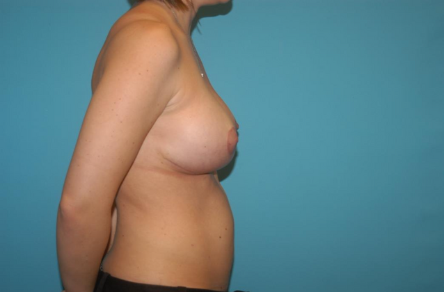 Breast Augmentation: Case 3 - After