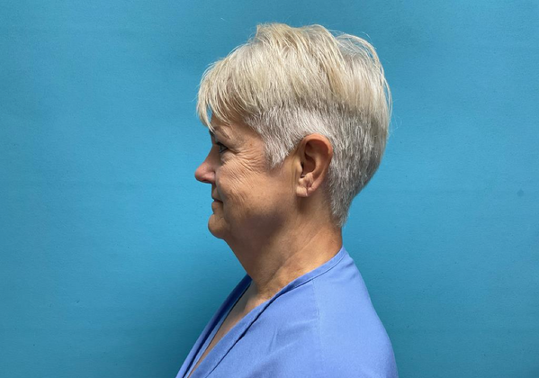 Facelift: Case 2 - Before