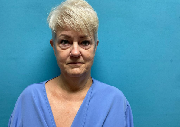 Facelift Case 2 - Before