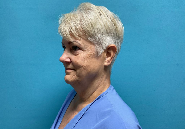 Facelift: Case 2 - Before