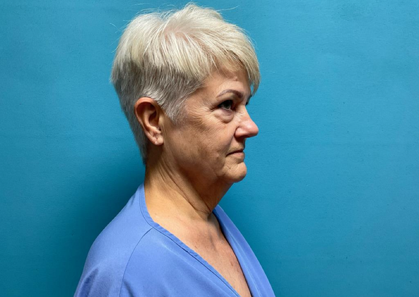 Facelift: Case 2 - Before