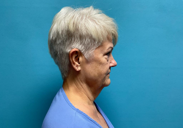 Facelift: Case 2 - Before