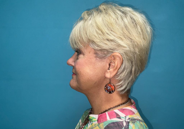 Facelift: Case 2 - After