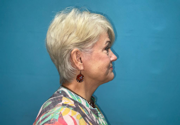 Facelift: Case 2 - After