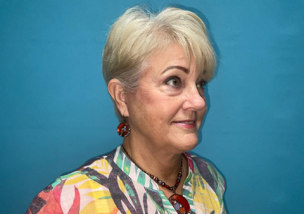 Facelift: Case 2 - After