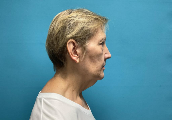 Facelift: Case 1 - Before