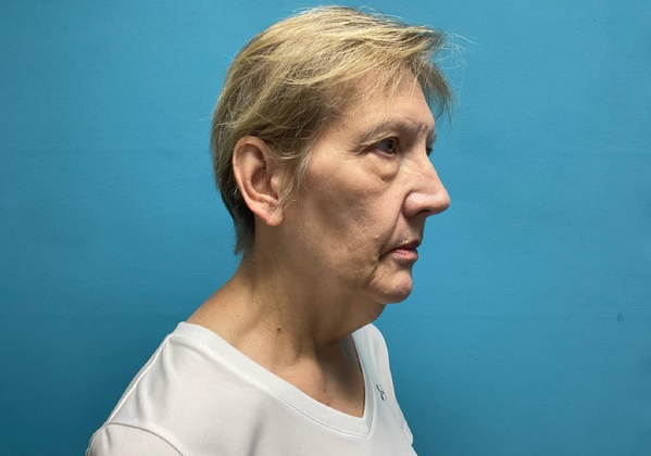 Facelift: Case 1 - Before
