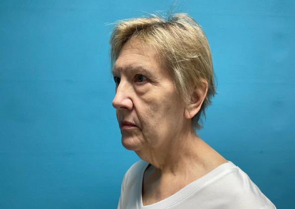 Facelift: Case 1 - Before