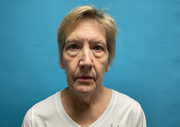 Facelift Case 1 - Before